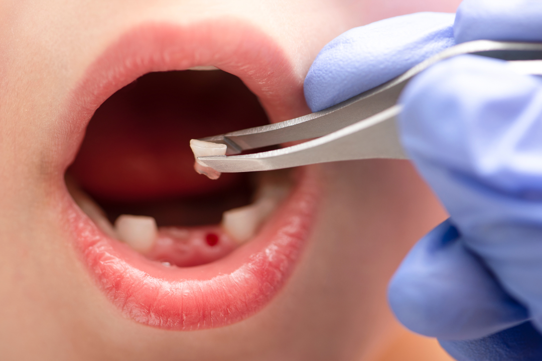 Baby-Teeth-Extraction at Namira Oro Dental Care